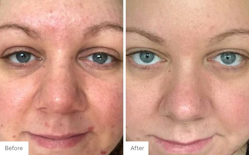6 - Before and After Real Results image of a woman's face.