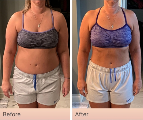 Before and After Real Result pictures of a person who has used the NeoraFit System - 1